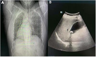 <mark class="highlighted">Laparoscopic Cholecystectomy</mark> in a Patient With Situs Inversus Totalis Presenting With Cholelithiasis: A Case Report